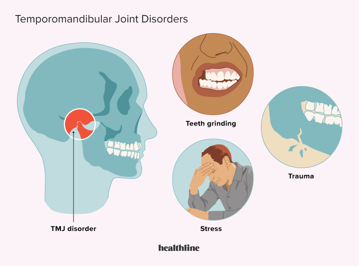 Sintomas que podem causar distúrbios temporomandibulares, como bruxismo e estresse