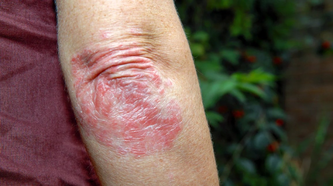 A psoríase < pan> psoríase leve geralmente causa sintomas da pele que não afetam 3-5 % da superfície corporal.